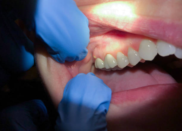Best Knocked-Out Tooth Emergency  in Wellington, UT